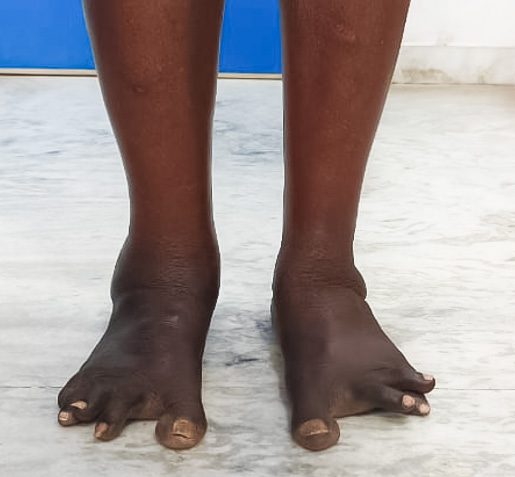 Case 1 clinical examination of ankle deformity and swelling