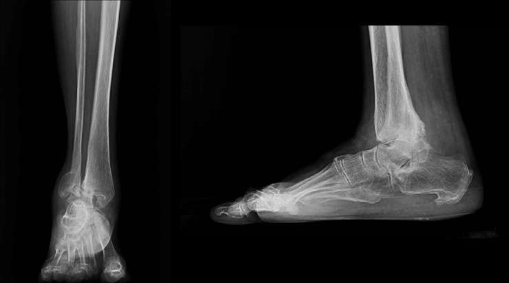 Case 1 preoperative X-ray showing malunited bimalleolar fracture ankle
