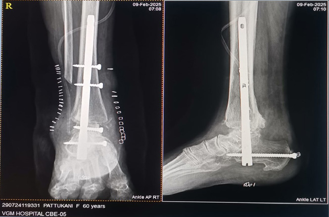 Case 1 ankle subtalar fusion using retrograde intramedullary nail