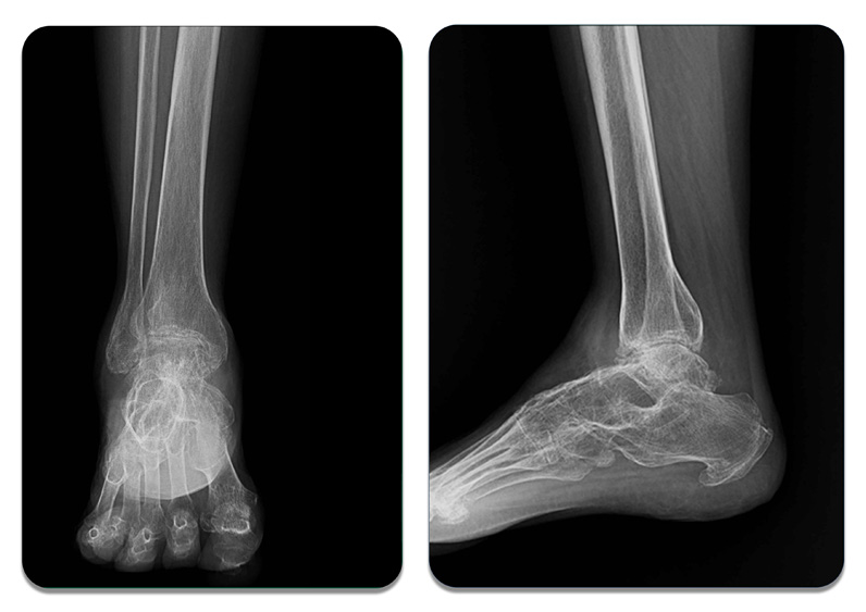 Case 2 radiographic evaluation showing severe ankle and subtalar arthritis