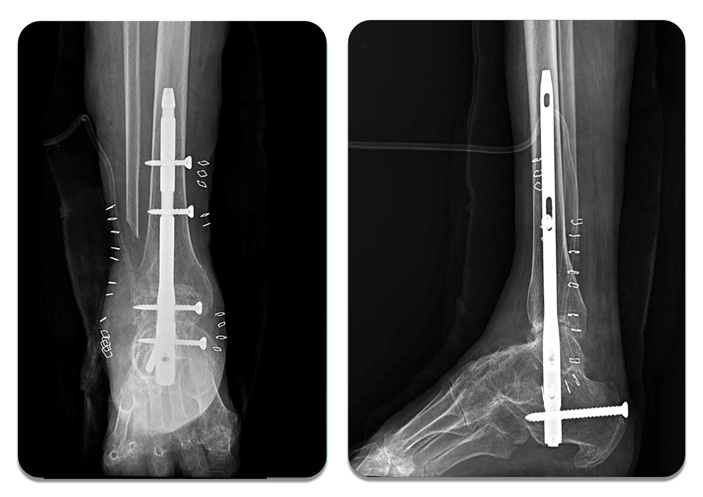 Case 2 postoperative ankle subtalar fusion using retrograde intramedullary nailing