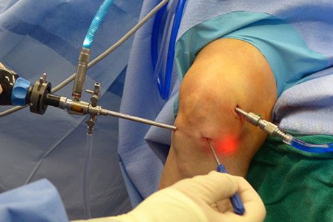 General Knee Arthroscopy Treatment in Coimbatore