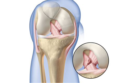 Multi ligament injury knee arthroscopy treatment in coimbatore