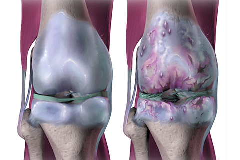Osteoarthritis Knee Arthritis Treatment in Coimbatore
