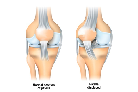 Recurrent Patella Dislocation - Knee Arthroscopy Treatment in coimbatore