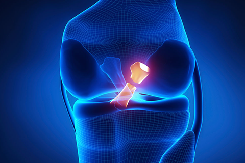 Posterior cruciate ligament (PCL) treatment in coimbatore