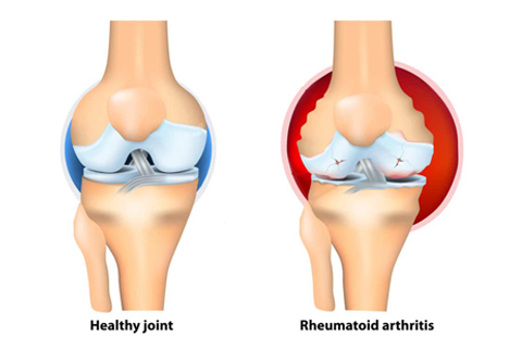 Rheumatoid Knee Arthritis Treatment in Coimbatore