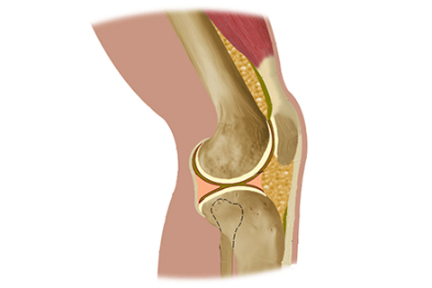 Septic Arthritis Knee treatment in coimbatore