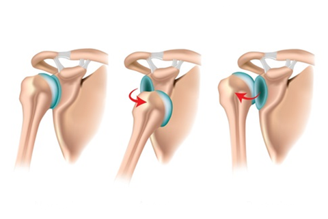 Recurrent dislocation of shoulder pain treatment in coimbatore