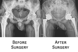 Hip Replacement Surgery in coimbatore