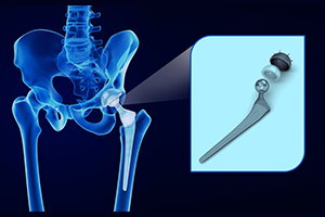 Hip Replacement Surgery in coimbatore