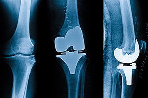 Knee Replacement Surgery in Coimbatore