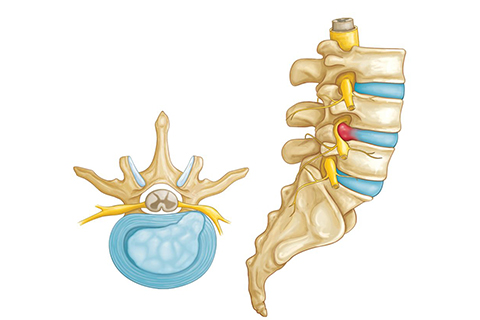 Disc Herniation treatment in coimbatore