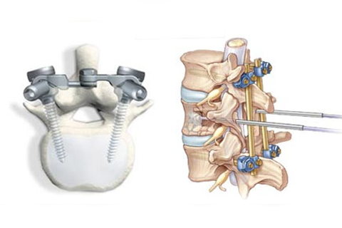 Spinal Fusion & Instrumentation treatment in coimbatore