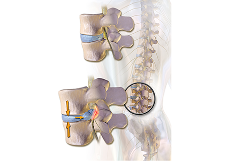 Spinal fusion surgery in coimbatore