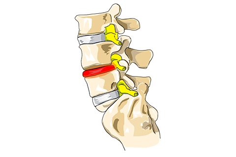 Spinal Instability treatment in coimbatore