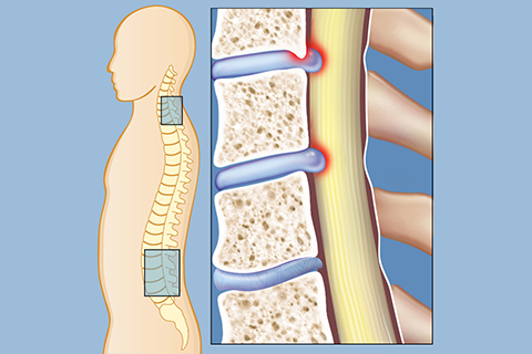 Spinal canal setnosis treatment in coimbatore