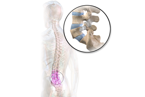 Spondylolysis - Spine surgery in coimbatore